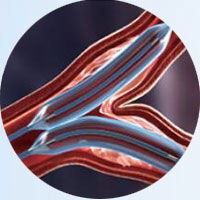 Coronary Perfusing Balloon